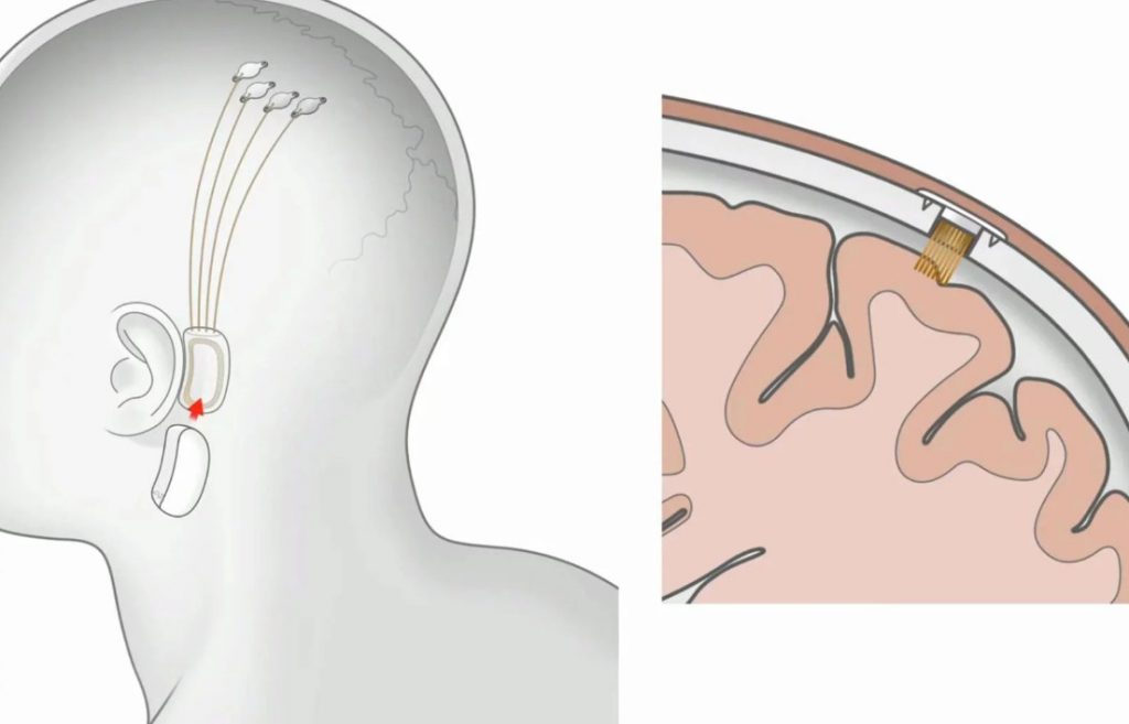 Neuralink chips elon musk