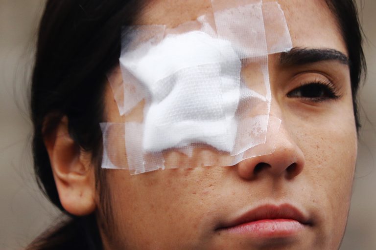 proyecto protesis oculares gratuitas u de chile FOTo agencia UNO