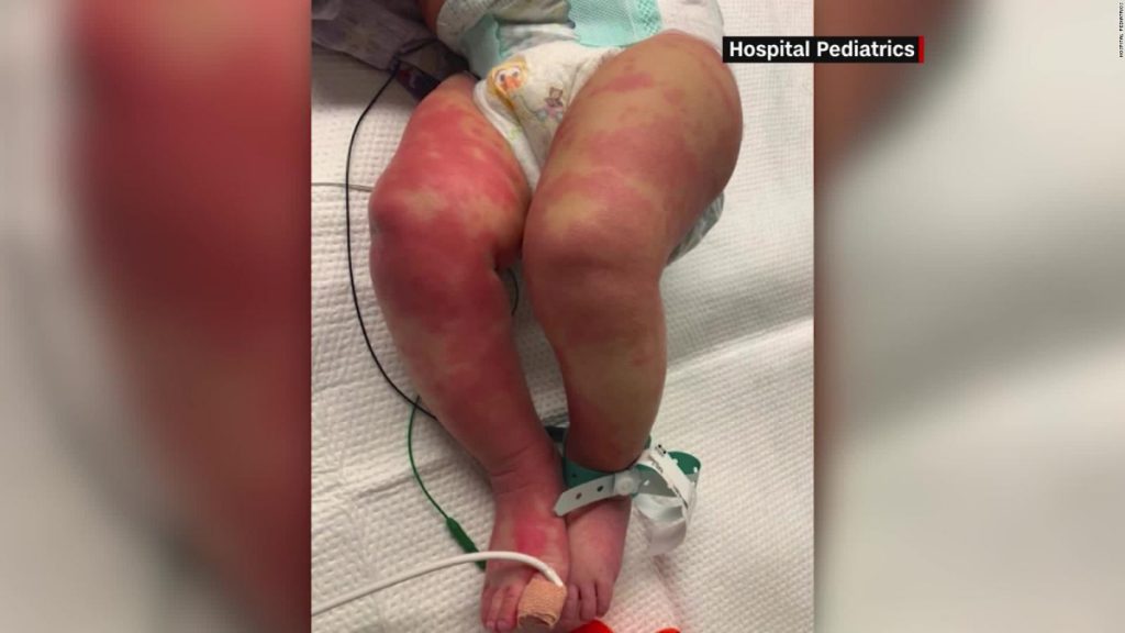 niños con sindrome inflamatorio multisistemico