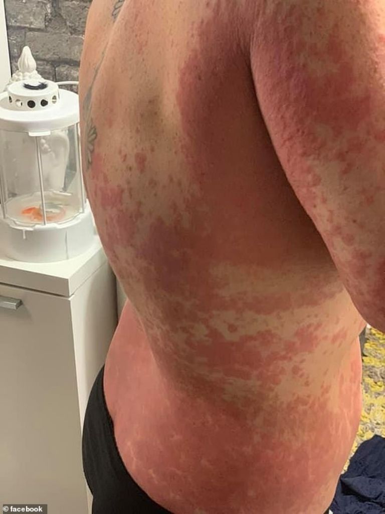 mujer reacción alergia vacunas astrazeneca