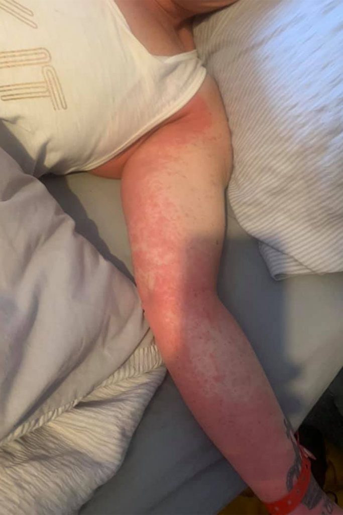 mujer reacción alergia vacunas astrazeneca