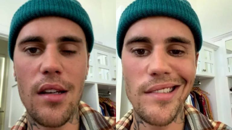 Justin Bieber Paralisis Facial