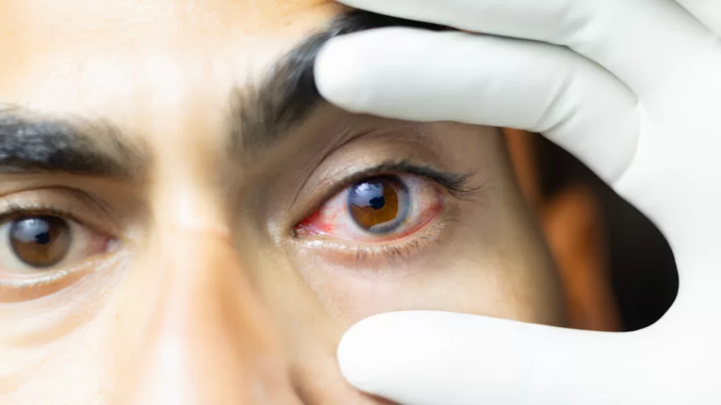 Bono PAD Glaucoma