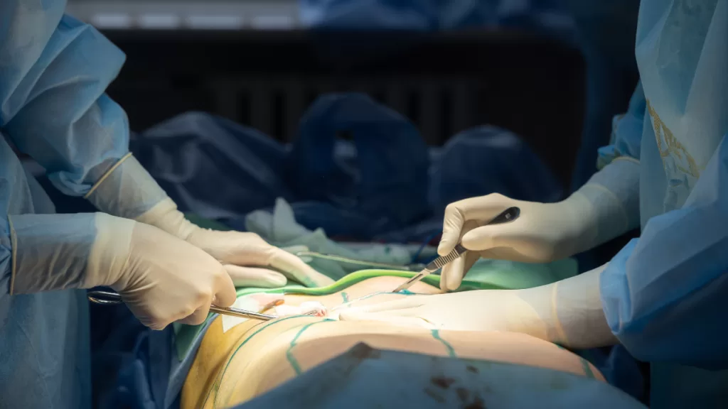 Bono Pad abdominoplastía
