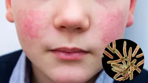 Eritema infeccioso