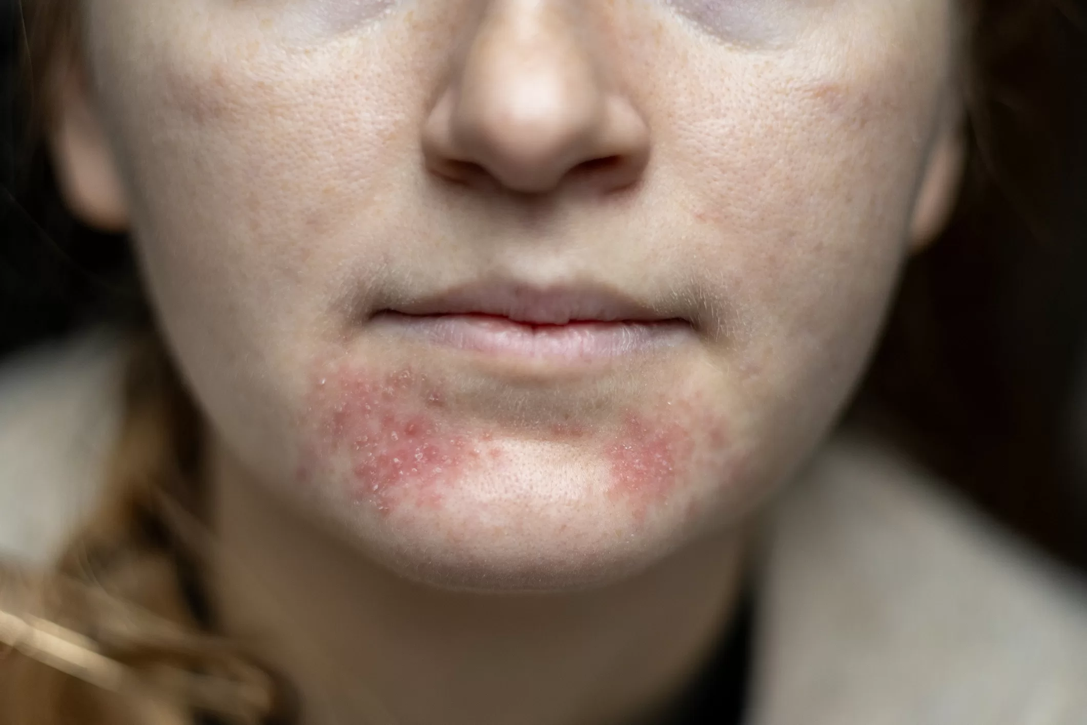 eritema infeccioso