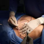 abdominoplastía