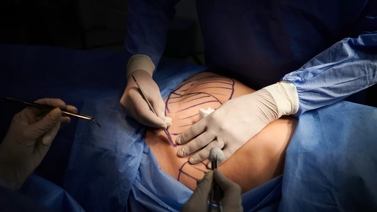 De $426 mil a $268 mil: así puedes pagar mucho menos por una abdominoplastía al momento de la operación