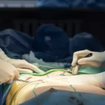 Abdominoplastía