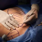 abdominoplastía bono
