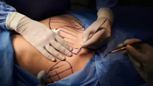 abdominoplastía bono
